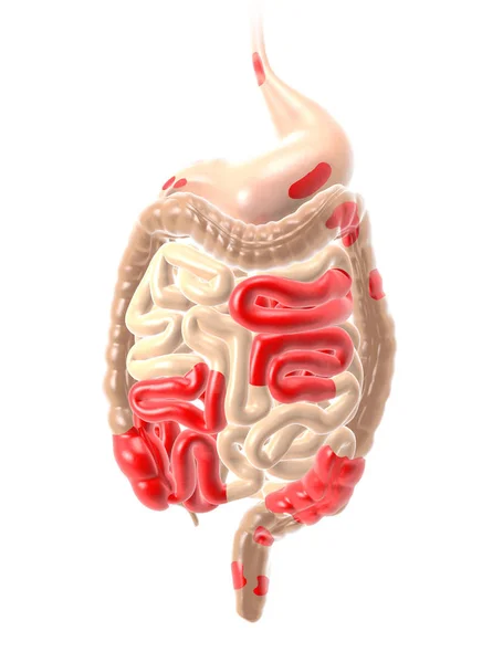 Crohn hastalığı, bir tür iltihaplı bağırsak hastalığı (Ibd), karın ağrısı — Stok fotoğraf