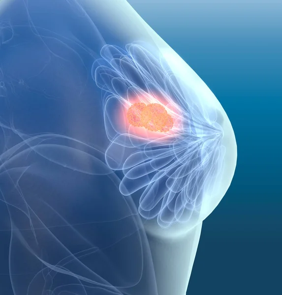 Cancer du sein avec lymphatiques, illustration médicalement 3D — Photo