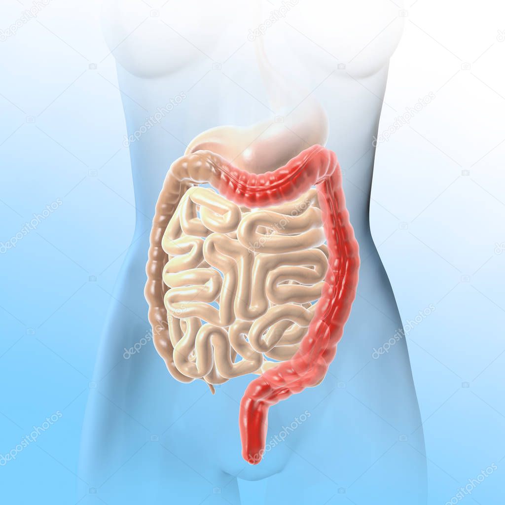 Ulcerative colitis (UC), inflammation and ulcers of the colon an