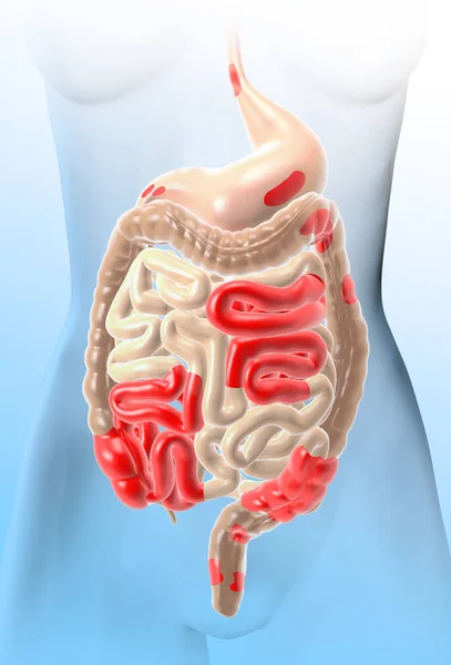 Crohn's disease, a type of inflammatory bowel disease (IBD), abd — Stock Photo, Image
