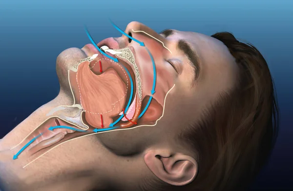 呼噜声，医学3D图解 — 图库照片