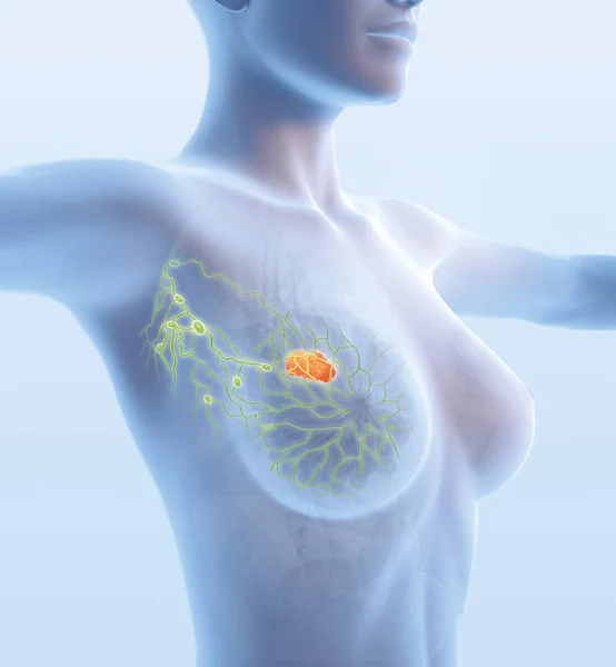 Cancer du sein avec lymphatiques, illustration médicalement 3D — Photo
