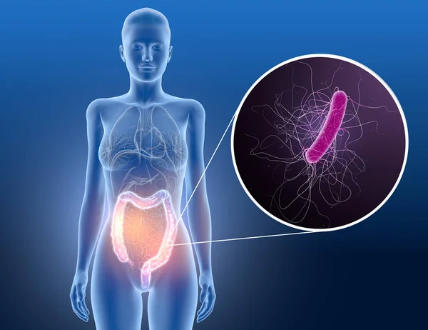 Colite, bactéria clostridium difficile no intestino grosso, sci — Fotografia de Stock