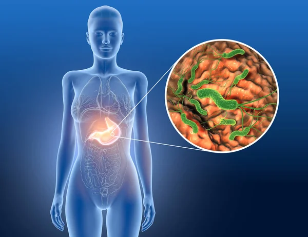 Mide iltihabı, helicobacter pillori bakterisi mukus tabakasına zarar veren ben.