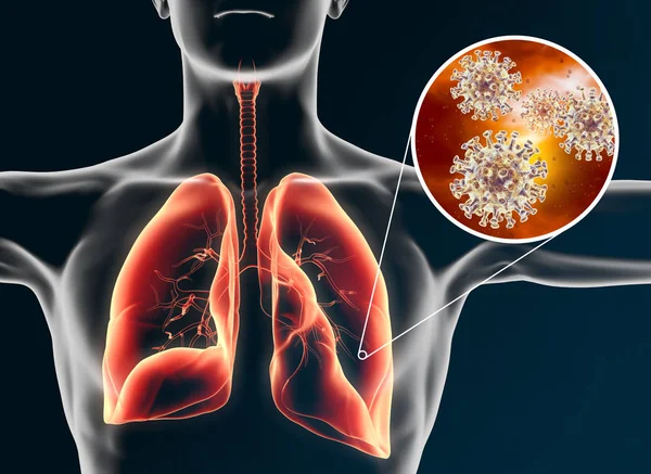 Coronavirus en pulmones humanos; neumonía, ilustración 3D — Foto de Stock