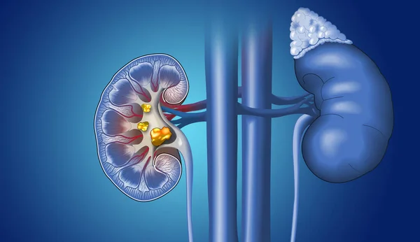 Medicamente Ilustração Mostrando Pedras Nos Rins Cálices Menores Maiores Ureter — Fotografia de Stock