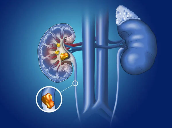 Medicamente Ilustração Mostrando Pedras Nos Rins Cálices Menores Maiores Ureter — Fotografia de Stock