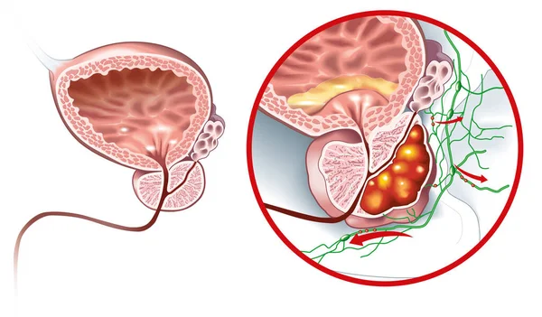 Ilustración Médica Que Muestra Glándula Prostática Sana Cáncer Próstata —  Fotos de Stock