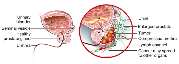 Illustration Médicale Montrant Une Prostate Saine Cancer Prostate — Photo