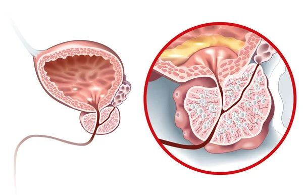 Ilustracja Pokazująca Zdrową Prostatę Łagodny Rozrost Gruczołu Krokowego Bph Powiększenie — Zdjęcie stockowe