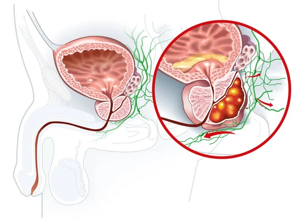 Illustrazione Medica Che Mostra Una Ghiandola Prostatica Sana Cancro Alla — Foto Stock