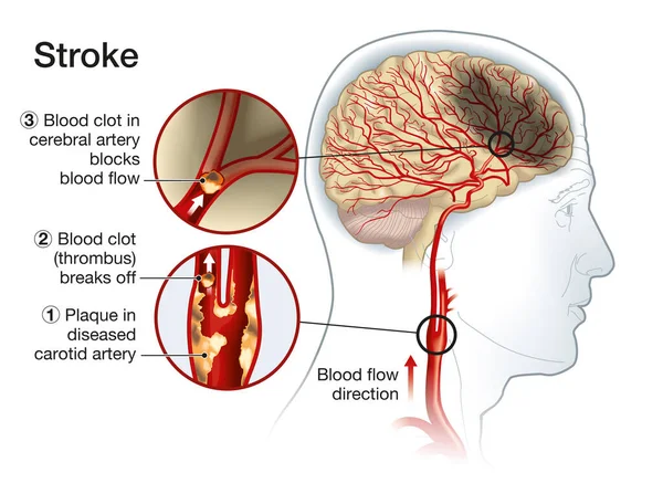 Ilustrace Ukazující Plak Krční Tepně Praskání Krevní Sraženiny Zablokování Průtoku — Stock fotografie