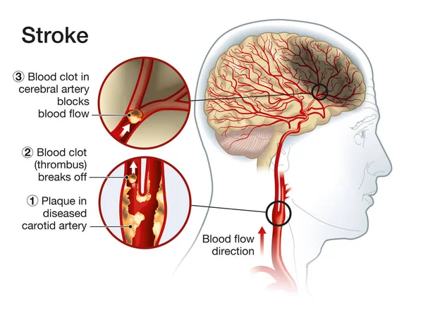 Illustration Montrant Plaque Dans Artère Carotide Caillot Sanguin Rompant Bloquant — Photo