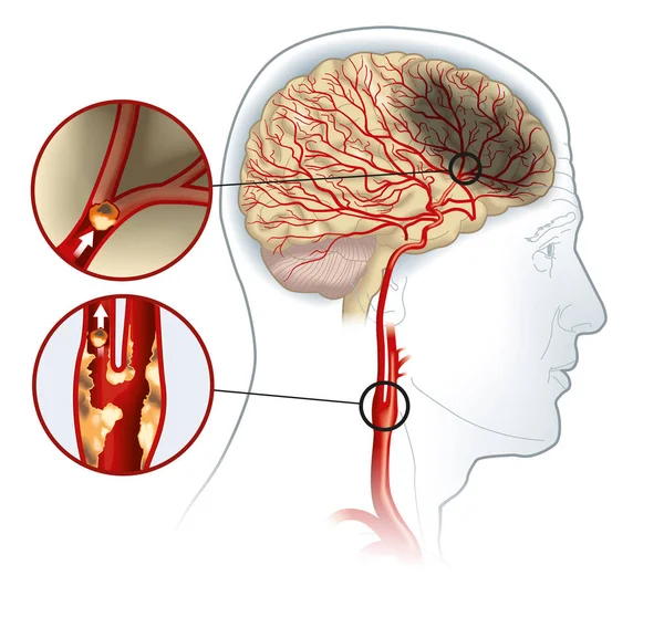 Illustrazione Che Mostra Placca Nell Arteria Carotidea Coagulo Sangue Che — Foto Stock