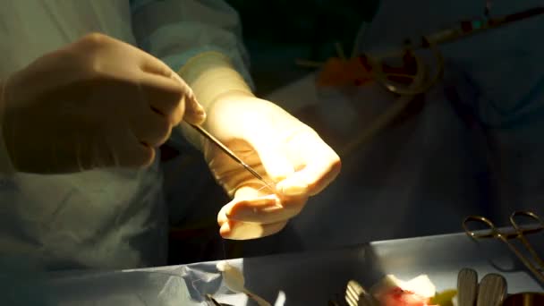 La operación en una persona es llevada a cabo por un cirujano experimentado — Vídeos de Stock