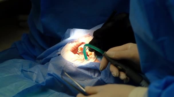 Врач-стоматолог проводит операцию по установке имплантата — стоковое видео