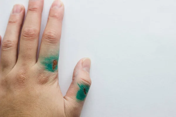 Een wond aan de arm. De wond is gezalfd met groen. gewonde arm. — Stockbeeld Een Wond Aan Arm Wond Gezalfd Met Groen Gewonde Arm Rechtenvrije Stockafbeeldingen