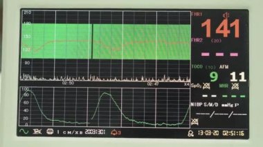 EKG monitörü kardiyograf. Rahimdeki bebek kalp atışlarının ölçümü sırasında kardiyograf görüntüsü.
