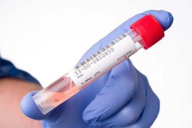 COVID 19 belirtileri gösteren bir hastayı test etmek için gerçek koronavirüs SARS-CoV-2 burun ve boğaz temizleme kiti. Virüs RNA için beslenme ortamına sahip tüpün içinde.