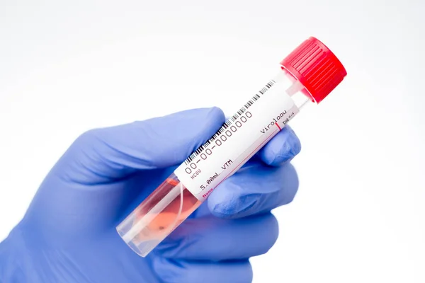 COVID 19 belirtileri gösteren bir hastayı test etmek için gerçek koronavirüs SARS-CoV-2 burun ve boğaz temizleme kiti. Virüs RNA için beslenme ortamına sahip tüpün içinde.