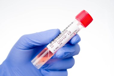 COVID 19 belirtileri gösteren bir hastayı test etmek için gerçek koronavirüs SARS-CoV-2 burun ve boğaz temizleme kiti. Virüs RNA için beslenme ortamına sahip tüpün içinde.