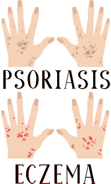 Psoriasis Eczema Diseased Skin Sore Hands Medical Poster Dermatology Venereology — Stock Vector