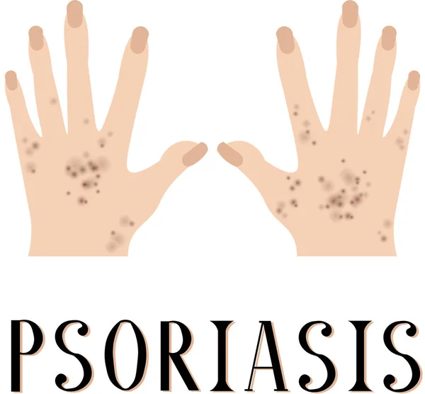 Psoriasis Diseased Skin Sore Hands Medical Poster Dermatology Venereology — Stock Vector