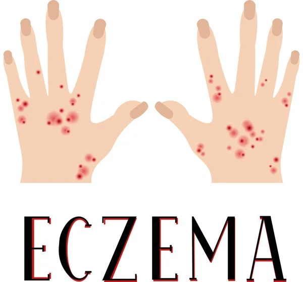 Eczema Pelle Malata Mani Sporche Manifesto Medico — Vettoriale Stock