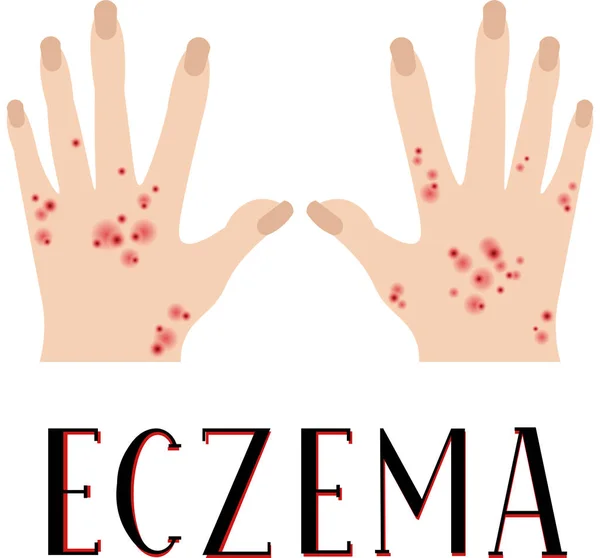 Eczema Pele Doente Mãos Chatas Cartaz Médico — Vetor de Stock