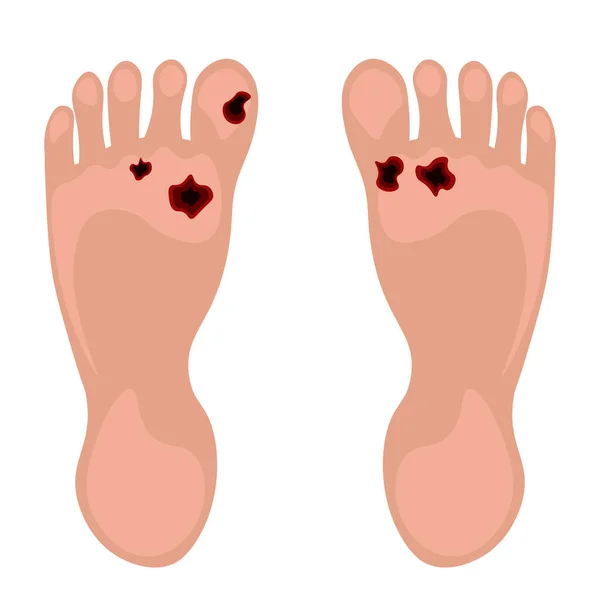 糖尿病の足 内分泌学的病理学 虚血性および手足のアテローム性動脈硬化症 ベクターイラスト — ストックベクタ