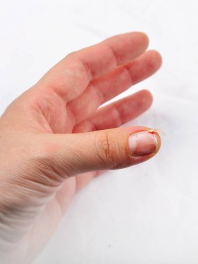 Beyaz arka planda tırnak soyma sorunu olan bir kadın eli..