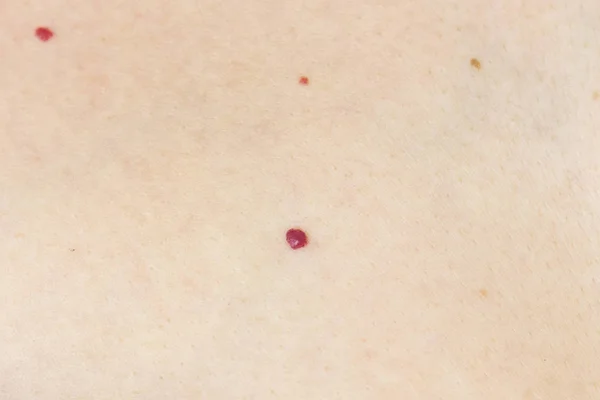 angioma. red mole on the skin. bursting vessel capillary. many angiomas in a small area of the body. close up.
