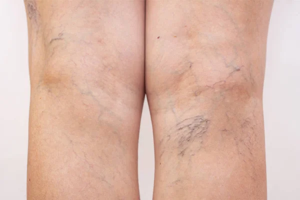 Female legs with varicose veins and leg spiders. The concept of human health and illness. White background. Vascular diseases, problems of varicose veins