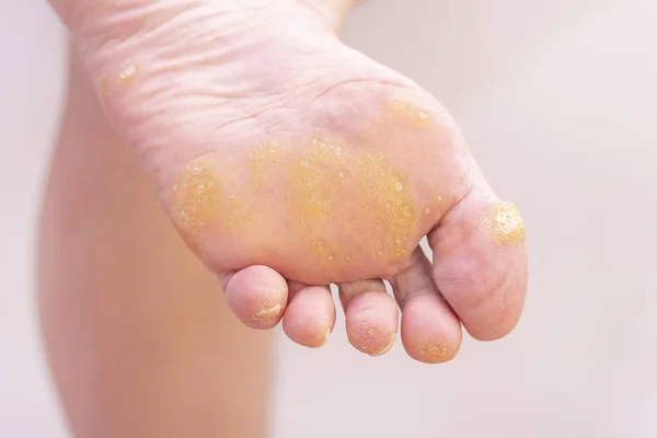 Bir kadının ayağında siğil ve nasır. Dermatoloji hastalığı. Plantar siğilleri. Dermatologla olan randevumda. Hafif arka planda siğilleri olan kadın ayağı..