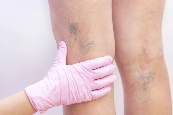 Varis damarlı dişi bacaklar. Cerrahların doktor randevusunda. Doktorlar eldiven takıyor. İnsan sağlığı ve hastalık kavramı. Vasküler hastalıklar, varis sorunları