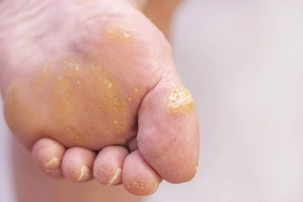 Bir kadının ayağında siğil ve nasır. Dermatoloji hastalığı. Plantar siğilleri. Dermatologla olan randevumda. Hafif arka planda siğilleri olan kadın ayağı..
