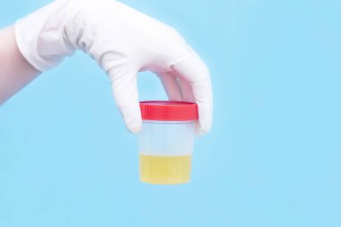 İdrarın tıbbi analizi. Doktor elinde kırmızı kapaklı bir kavanozda idrar testi tutuyor. Sağlık ve İlaç.