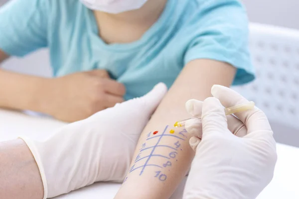 Prueba Alérgenos Mano Niño Sometido Procedimiento Prueba Cutánea Alérgenos Clínica —  Fotos de Stock