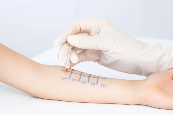 Allergen Test Hand Child Undergoing Procedure Allergen Skin Test Clinic — Stock Photo, Image