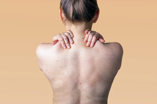 女人背部皮肤上的过敏性皮炎 皮肤病 神经性皮炎 湿疹或过敏性皮疹 保健和医疗 靠近点复制空间为Tex — 图库照片