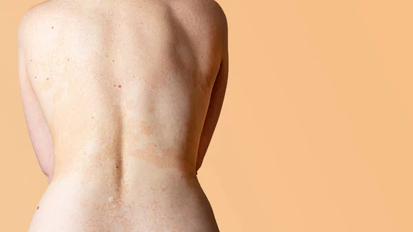 女人背部皮肤上的过敏性皮炎 皮肤病 神经性皮炎 湿疹或过敏性皮疹 保健和医疗 皮肤的脱皮 文本复制空间 — 图库照片