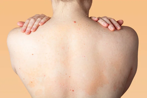 Allergische Dermatitis Auf Der Rückenhaut Einer Frau Hautkrankheiten Neurodermitis Ekzeme — Stockfoto