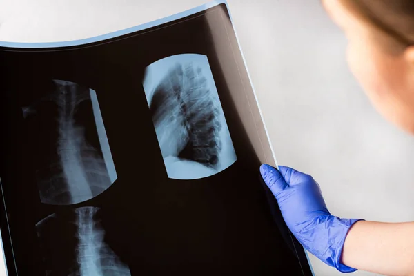 Женщина Врач Осматривает Рентгеновскую Пленку Сканер Грудной Клетки Концепция Медицинского — стоковое фото