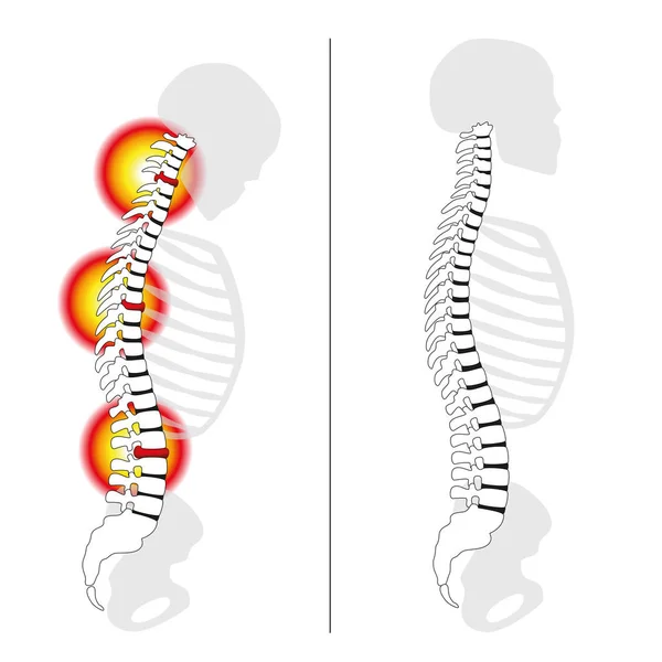 Espina dorsal con prolapso de disco deslizado — Vector de stock