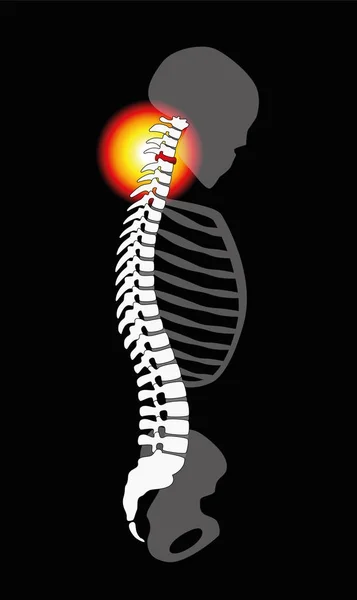 Spinal Disc Prolapse Neck Pain Cervical Vertebrae — Stock Illustration Spinal Disc Prolapse Neck Pain Cervical Vertebrae Stock Vector