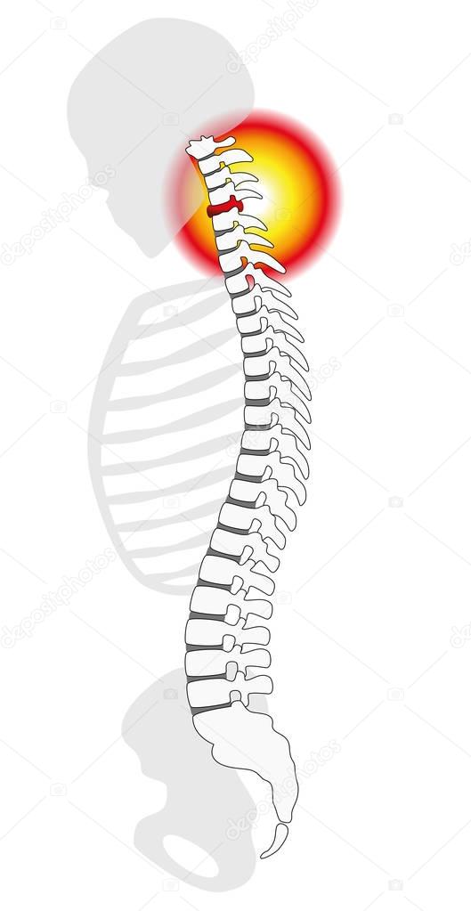 Neck Pain Cervical Vertebrae Spinal Disc Prolapse