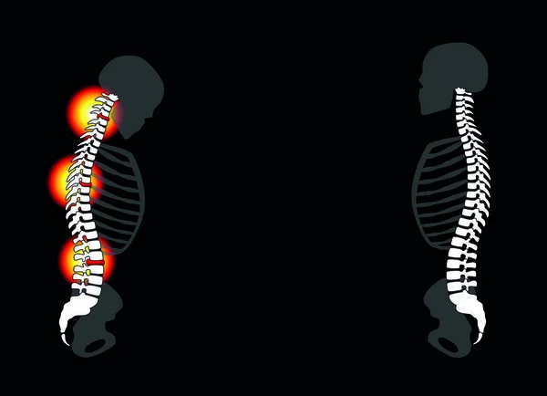 背部疼痛回落椎间盘突出症健康 — 图库矢量图片