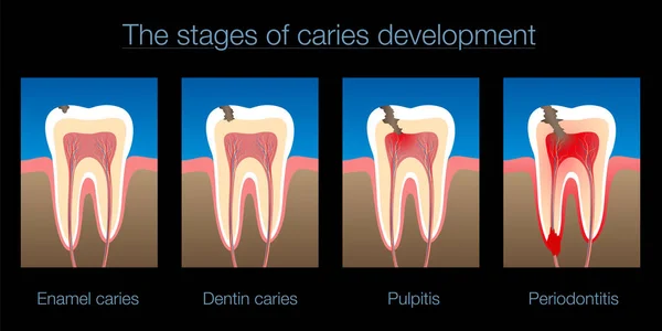 蛀牙发展阶段 牙釉质和牙龈 牙髓炎和牙周炎 黑色背景上的孤立矢量图解 — 图库矢量图片