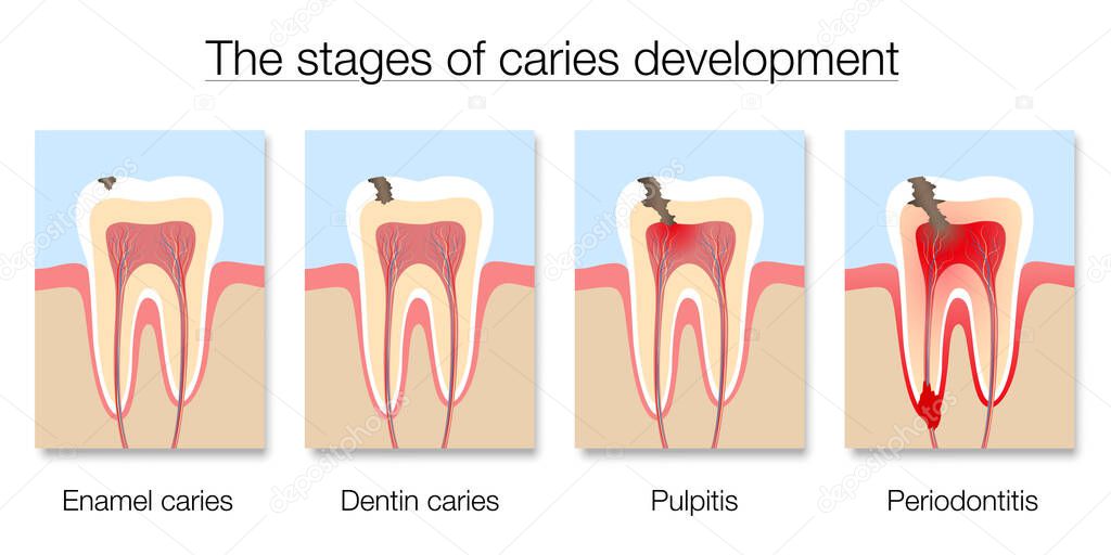 Caries stages chart, development of tooth decay with enamel and dentin caries, pulpitis and periodontitis. Isolated vector illustration on white background.