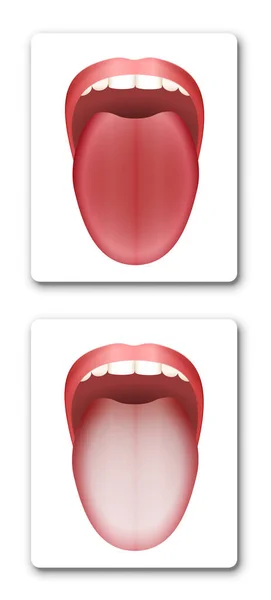 健康的な舌とコーティングされた白い舌を比較してきれいにする 白い背景に孤立したベクトルイラスト — ストックベクタ